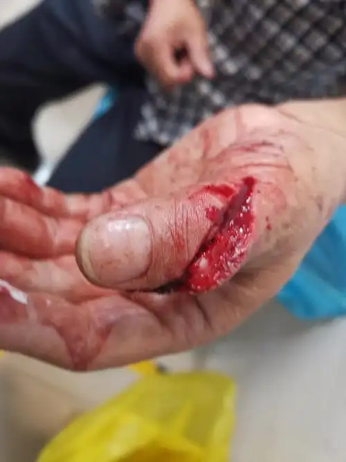 骨四科肢体重建病例集锦