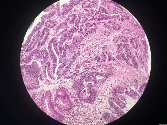 直肠活检腺癌2017.1.12【91360消化沙龙病例226】