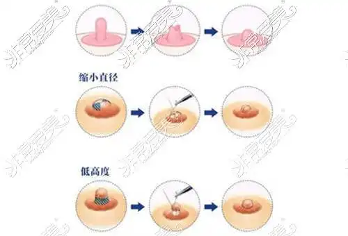 贵阳做乳头整形哪家好乳头乳晕缩小哪家整形医院能做