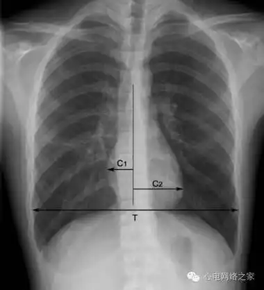 shs具有特征性的x线表现,心影小而狭长,各弧度平滑,心膈间隙较宽,长轴