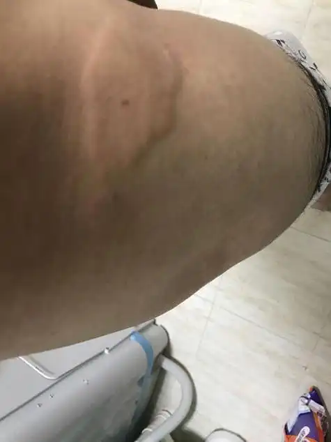 屁股和腿上有了30几个大包.怎么办?