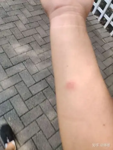 结核ppd皮试这样正常吗