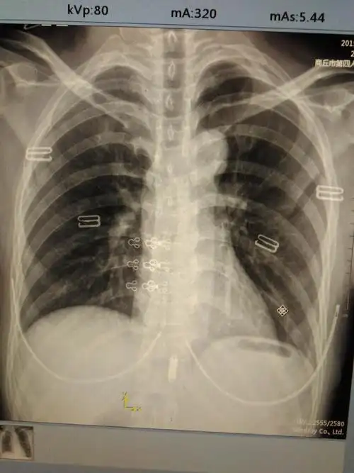 隐逸性肋骨骨折