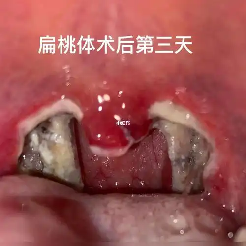豆腐脑_面条_麻辣烫_火锅_蒸蛋_扁桃体手术_医疗健康_医疗健康其他