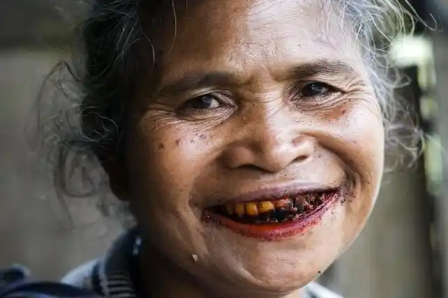 常年吃槟榔所导致的牙齿发黑.