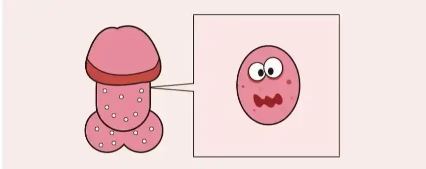 得了龟头炎不要忙着吃药,先弄清楚这6种类型!_邢台广慈医院
