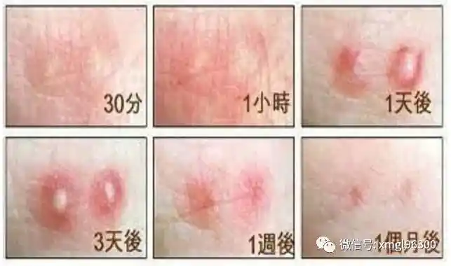 【鹭城路事】勇斗虫害--红火蚁