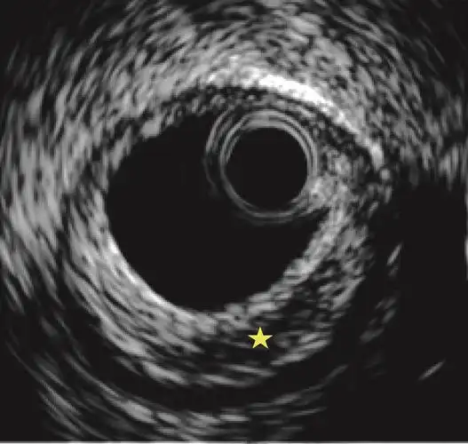 图4-2-3 脂质斑块