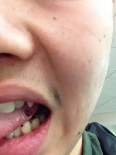 我的舌头上起了个泡 红色的很疼.