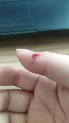 被老鼠咬到的伤口