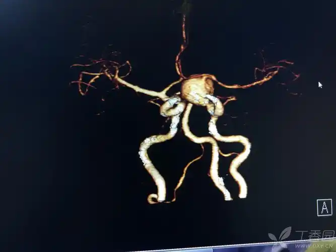 一例典型脑动脉瘤破裂出血 [病例帖]