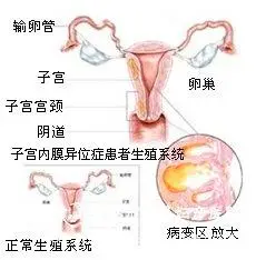 子宫内膜异位症