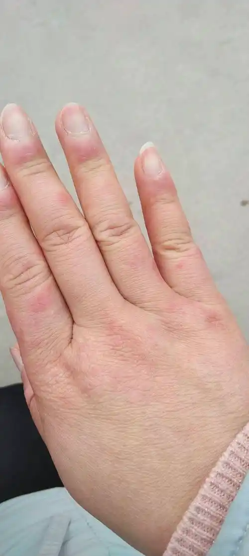 是冻疮还是红斑