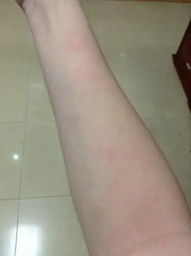 好几天这样了 不痒没感觉 只是两只手臂长了 是对什么过敏吗