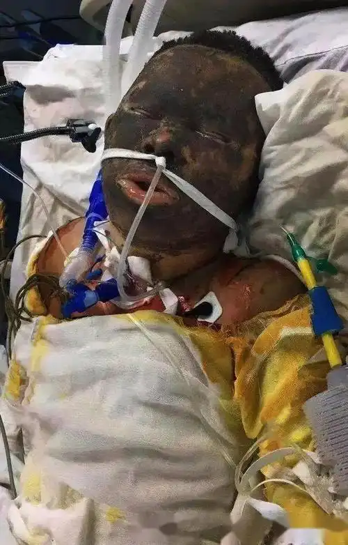 天理何在男子钓鱼不慎触电双手截肢鱼塘老板却拒绝赔偿