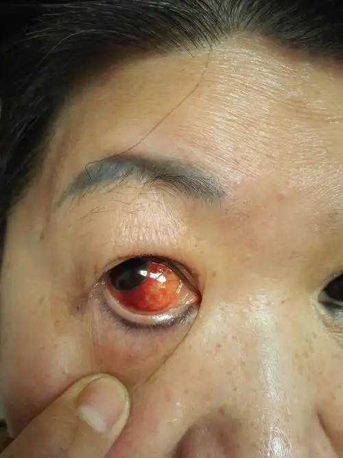 我妈妈的眼睛突然结膜充血,自己没有碰到眼睛,她正在使用氧佛沙星