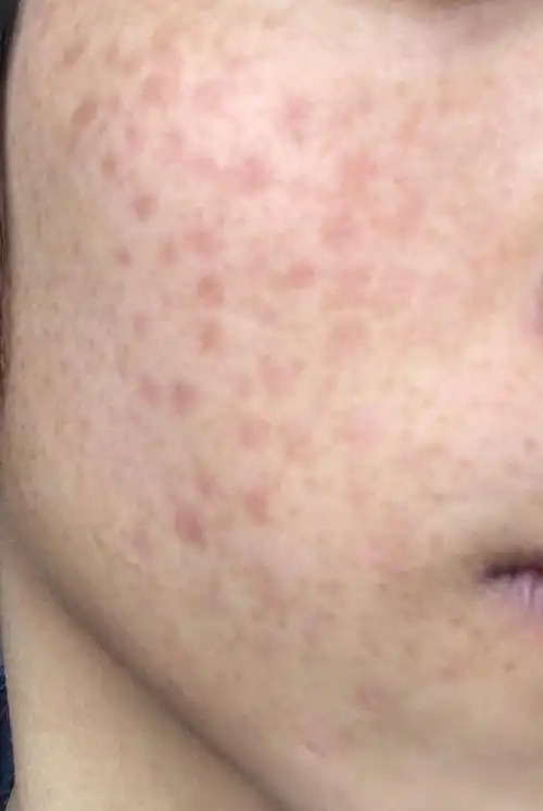 脸上有雀斑样痣,点药了,痂一个月才掉完,掉完到现在一个多月了,一直