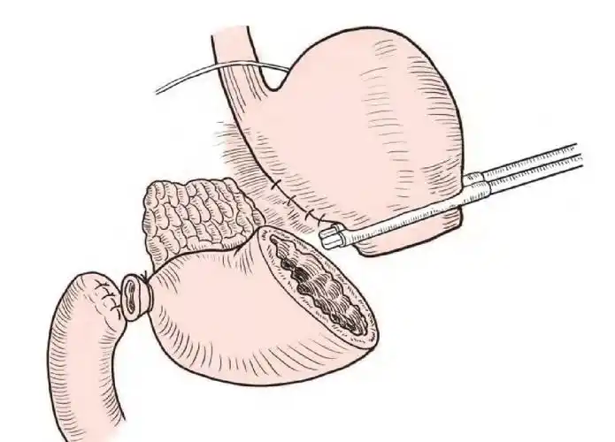 第十一节 胃癌根治性远端胃大部切除术-普通外科手术-医学