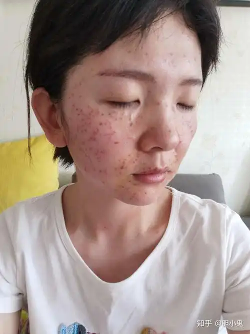 记录我的激光祛斑过程