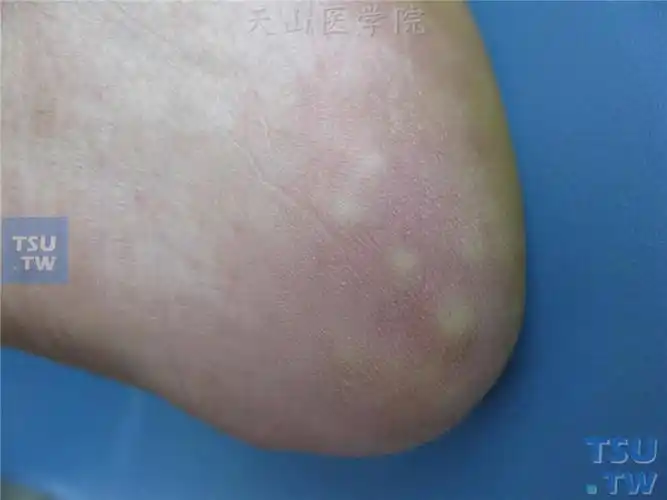 痛性脂肪疝painfulfatherniation症状表现