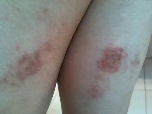 大腿这是什么症状