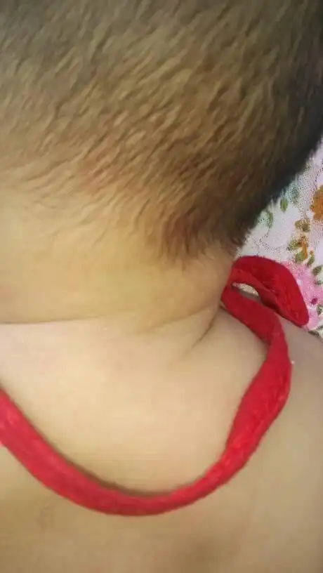 宝宝两个月大勒,后面脖子上刚长的针眼大的白泡,如图,这是什么?