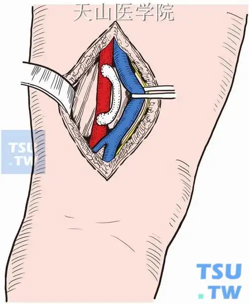 腘动脉松解和重建术 - 外科手术学 - 天山医学院