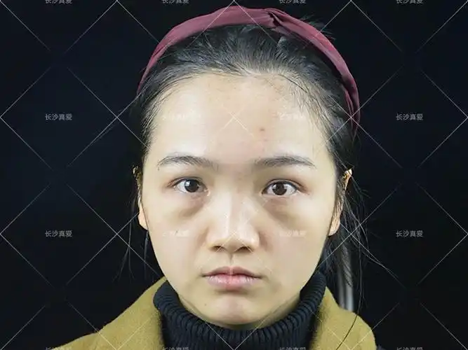 年纪轻轻的不熬夜也出现了眼袋,除了脂肪疝出更多的原因是中面部凹陷
