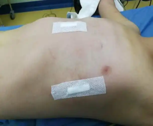 nuss手术失败后的wang手术nuss手术为什么失败