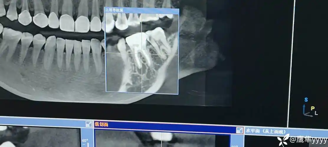 求助本人患牙根管治疗后发现又出现一根尖囊肿求助各位大佬能不能保牙