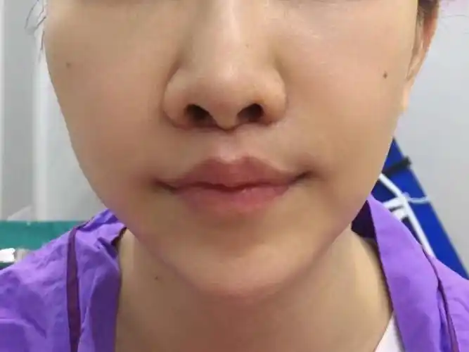 短人中人中缩短案例分享整形医生案例大赏