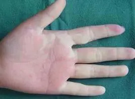 法乐四联症是常见的先天性心脏血管畸形,在紫绀型先天性心脏病