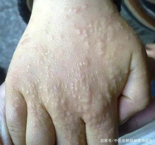 当小孩手上出现密集小丘疹,可能和这些玩具有关.