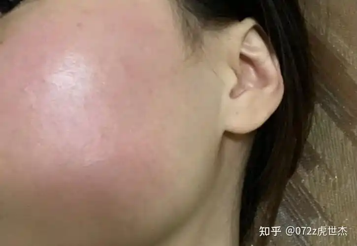 怎么能去红血丝有红血丝怎么办