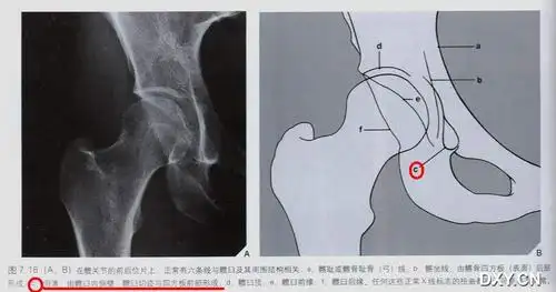 髋臼泪点指的是哪里