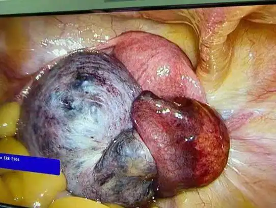 女孩卵巢囊肿蒂扭转480哈医大一院群力院区妇科专家提醒会影响生育