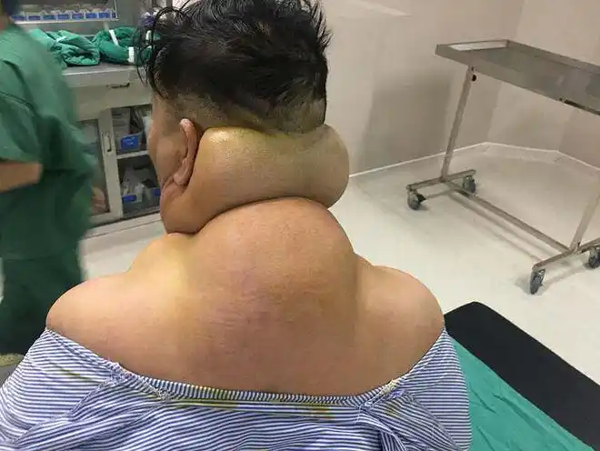51岁男子患罕见病,颈部"变形"导致无法躺下,或与平时饮酒有关|脂肪瘤