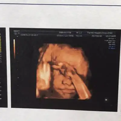 今天照了三围,但看图片,宝宝好像有点是兔唇,但b超单上又写"上唇皮肤