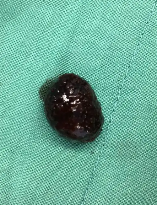 单发的胆囊结石可以首先考虑腹腔镜联合胆道镜保胆取石手术_胆囊结石