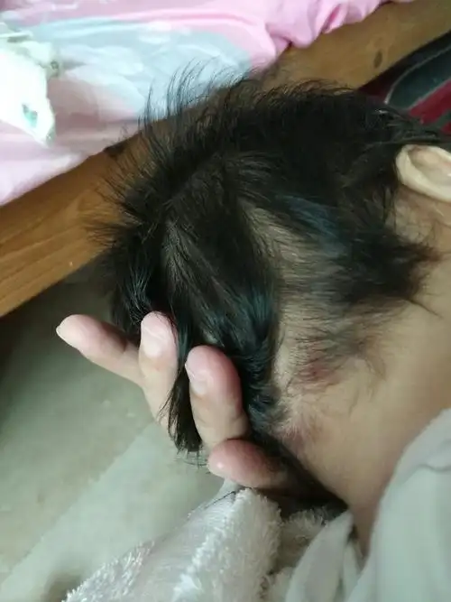 后脑勺磕个大包怎么办 后脑勺磕个大包怎么办怎么消肿