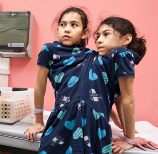 连体人其中一个吃饱饭另一个是不是不饿了看完涨见识了