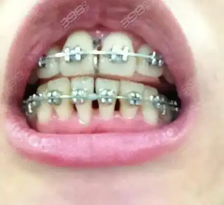 一定要做好口腔清洁,不然黑三角,牙龈增生,脱矿,龋齿,牙周病这些就会