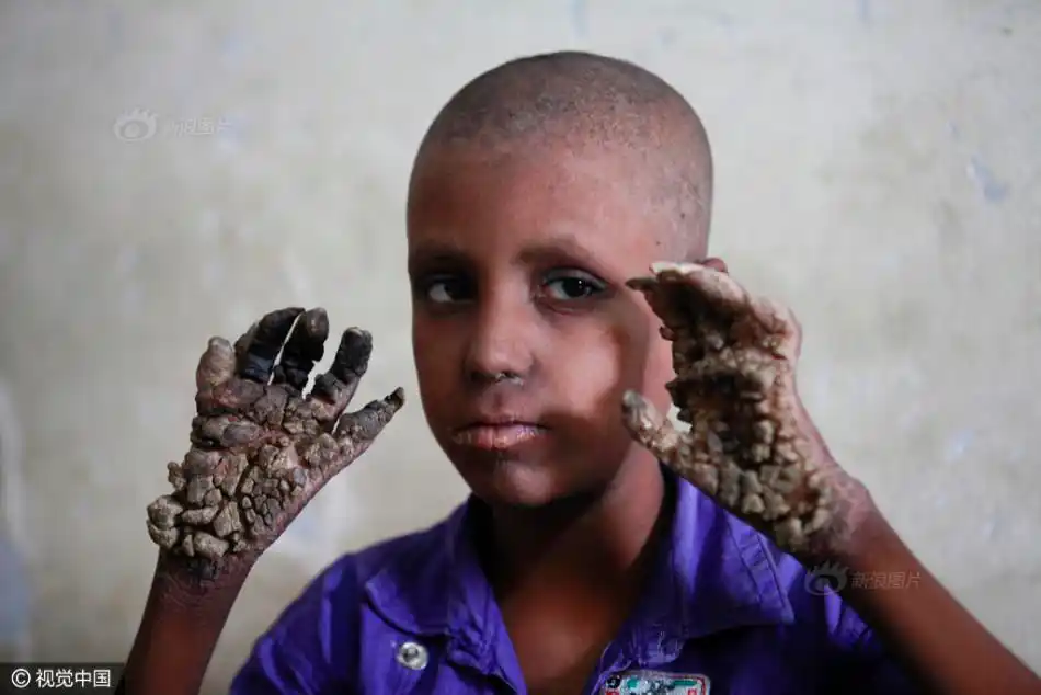 7岁男童患"树人病" 手脚长出树根树枝_高清图集_新浪网