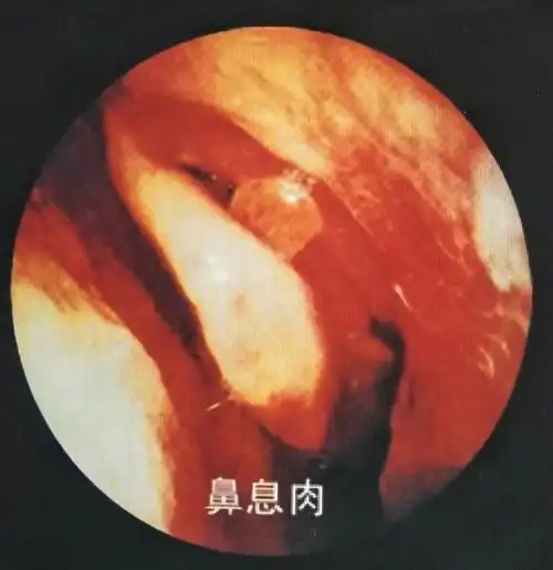 鼻息肉是肿瘤吗