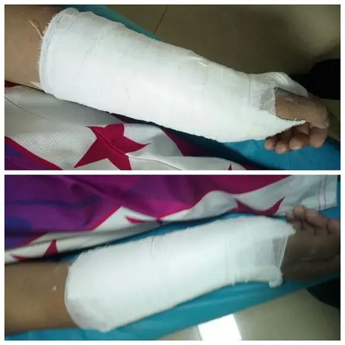 儿童双侧史密斯骨折