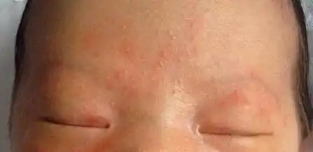 宝宝湿疹只会在夏季发生?错,天气转凉,宝宝更易患上干性湿疹