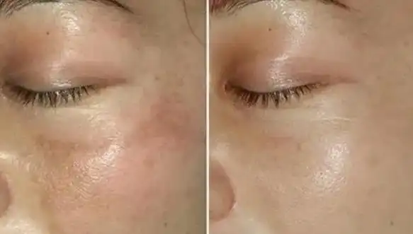 做完超皮秒祛斑之后多久可以化妆,超皮秒做完后注意事项