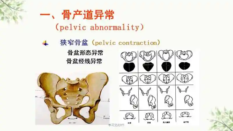 产道异常的分类和临床表现课件
