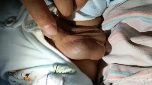 孩子俩月大,今天孩子尿时发现右侧睾丸上肿了个大泡