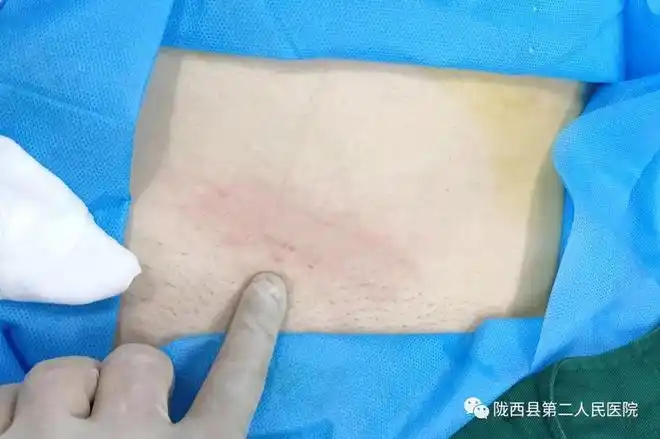 超声介入县二院成功完成2例超声引导下子宫肌瘤射频消融术